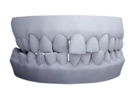 3D model of cross-bite malocclusion for clear aligner treatment planning
