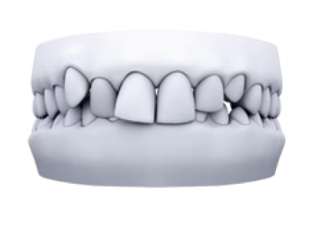 3D model of dental crowding case for clear aligner treatment planning