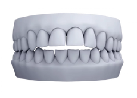 3D model of open bite malocclusion for clear aligner treatment planning
