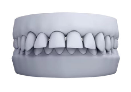 3D model of overbite malocclusion for clear aligner treatment planning