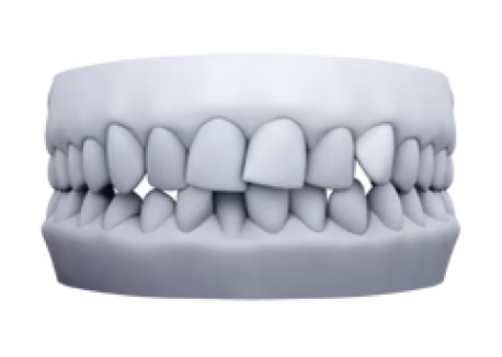 3D model of tooth rotation case for clear aligner treatment planning