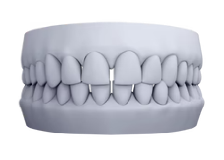 3D model of tooth spacing case for clear aligner treatment planning