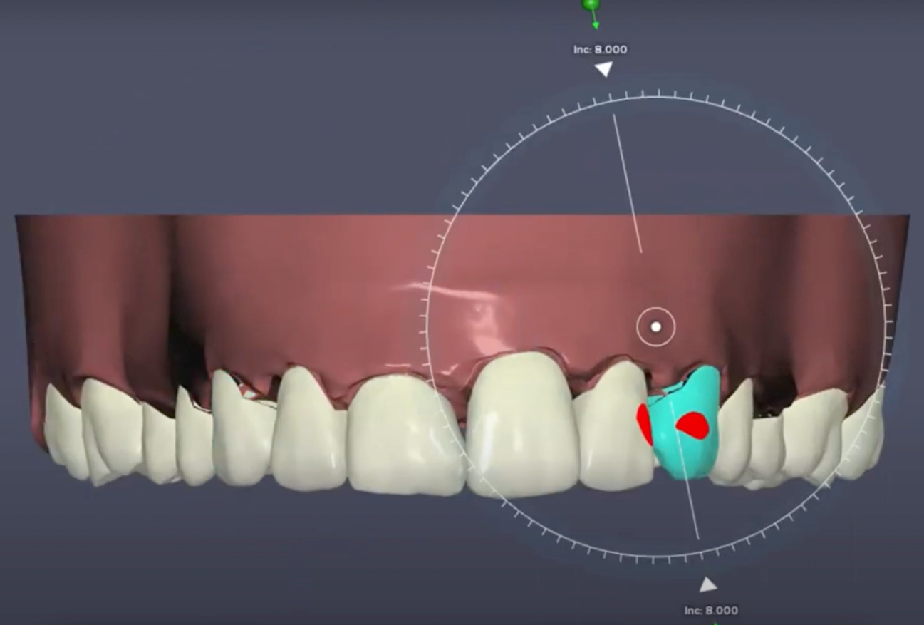 Ex-Invisalign clinician reviewing a 3D clear aligner treatment plan