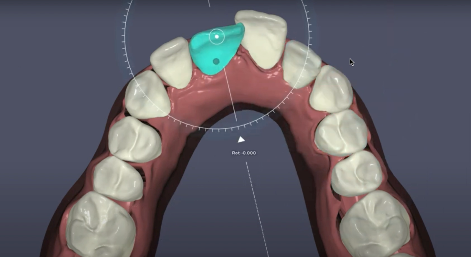 3D digital clear aligner treatment plan, occlusal view of teeth setup